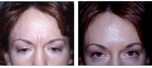 Botox  ( Botulinum Toxin )