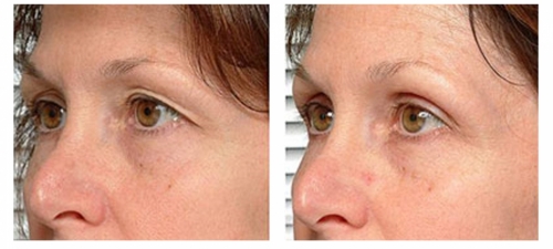 Ultraformer Eyelids