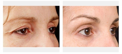 Ultraformer Eyelids