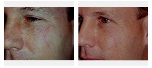 Scars