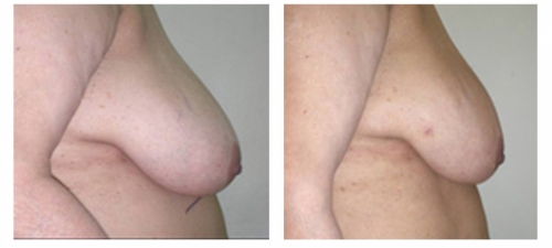 Scarless Liposuction Breast Reduction Before and After  