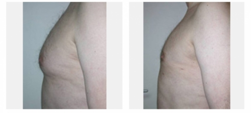 Liposuction Breasts