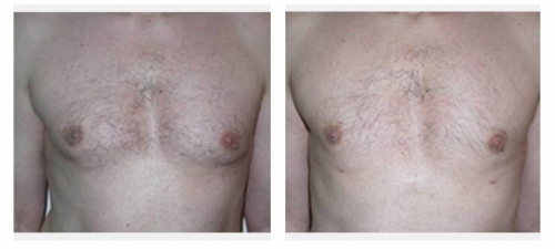 Liposuction Breasts