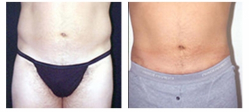 Before and after liposuction of love handles