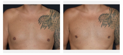 Liposculpture for gynecomastia 