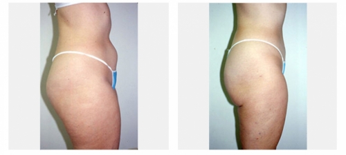 Before and 1 month after liposculpture of the abdomen and thighs
