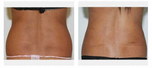 Before and 4 days After Liposuction 
