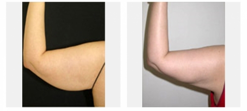 Before and after liposuction of the arms