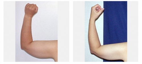 Before and after liposuction of the arms
