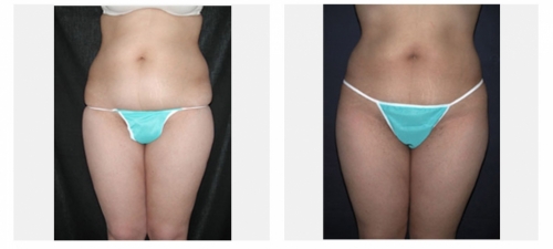 Liposculpture reshaping of the waist