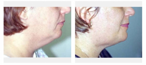 Before and 1 month after liposculpture of the neck without any other intervention.
