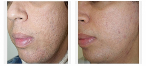 PEARL Laser for Acne Scars 