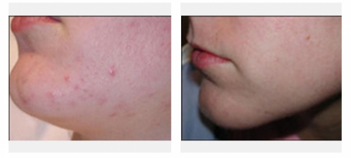 Resistant acne after laser treatment