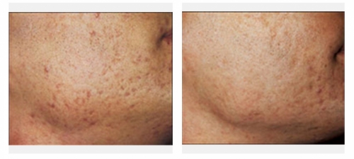 Before and after laser treatment of scars