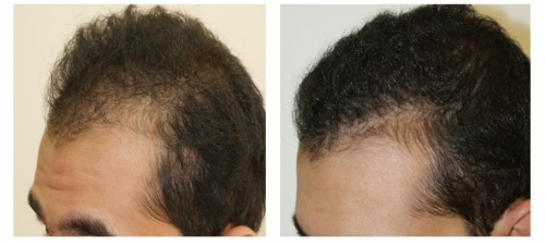 Density hair transplantation