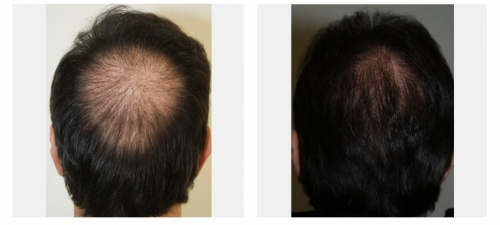 Crown Hair Transplantation