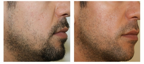 Beard Transplantation