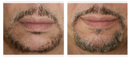 Beard Transplantation