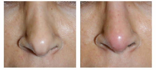 Non surgical Rhinoplasty