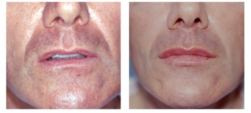 Men Lip Filler