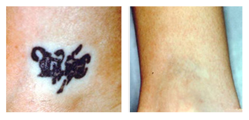 Top Tattoo Removal in Faridabad NIT, Delhi - Best Permanent Tattoo Removal  - Justdial